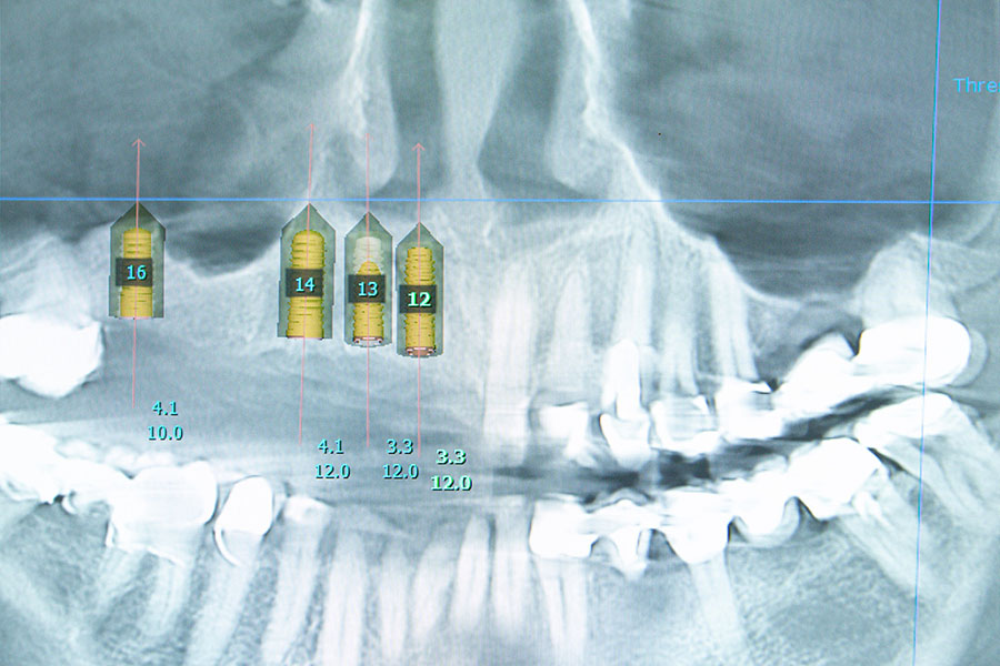 3D Implantatplanung